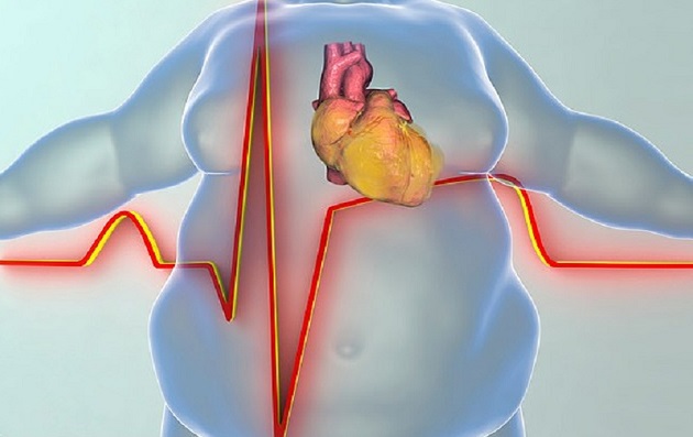 Béo phì là nguyên nhân dẫn đến bệnh tim mạch