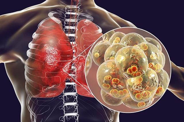 Viêm phổi là một căn bệnh phổ biến